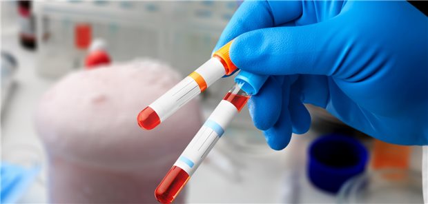 Test auf Hämophilie B: Bei Betroffenen lässt sich nach Infusion von Etranacogen dezaparvovec eine anhaltende Faktor-IX-Aktivität erzielen.
