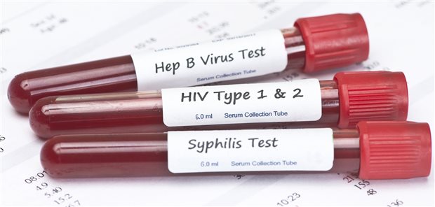 Test auf verschiedene STI: Die Neudiagnosen von Syphilis nehmen in Deutschland zu.