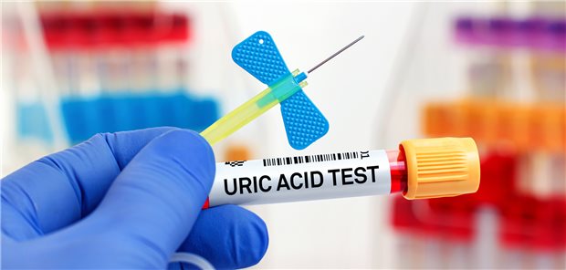 Teströhrchen und Nadel für den Harnsäuretest: Leiden KHK-Patienten nicht an Gicht, profitieren sie bei erhöhten Harnwerten nicht von einer Harnsäure-senkenden Therapie!
