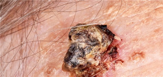 Fortgeschrittenes Basalzellkarzinome: Sie sind eine therapeutische Herausforderung für Arzt und Patient. 