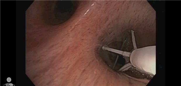 Thermoplastiesonde im Bronchialsystem: Die Behandlung führt zu einem vergrößerten Atemwegsvolumen bei vergleichbarer Lungenausdehnung und vermindertem Air trapping. Dadurch reduziert sich die Überblähung der Lunge und die inspiratorische Kapazität der Patienten nimmt zu.