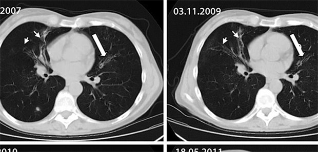 Thorax-CT der Lunge im Verlauf: Bronchiektasen in Mittellappen (Pfeile) und Lingula (Blockpfeil); passager flaue noduläre Verdichtung im rechten Unterlappen.