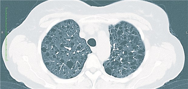 Wenn keine Diagnose gestellt werden kann Thorax-CT einer Patientin mit mittelgradig ausgeprägter LAM mit typischen blasenartigen Veränderungen des Lungengewebes.