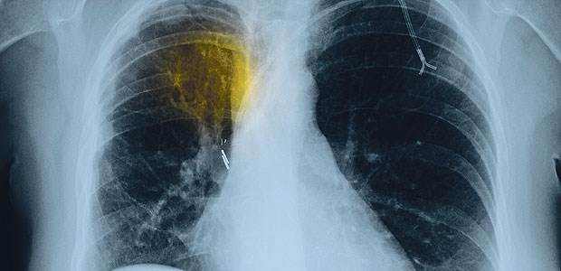 Thorax-Röntgen-Aufnahme einer Patientin mit fortgeschrittenem nichtkleinzelligen Bronchial-Ca.