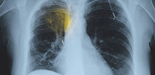 Thorax-Röntgen-Aufnahme einer Patientin mit fortgeschrittenem nichtkleinzelligem Bronchial-Ca.