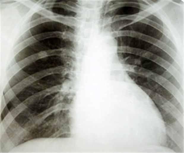 Thorax-Röntgen taugt nicht zur Krebsfrüherkennung Thorax-Röntgen-Untersuchungen haben "keinen wesentlichen Nutzen", um Todesfällen durch Bronchialkarzinome vorzubeugen, so US-Forscher.