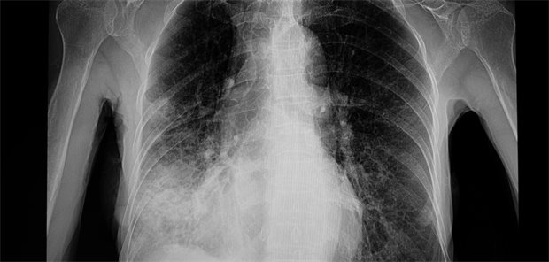 Thorax-Röntgenaufnahme eines Patienten mit Pneumonie im rechten Lungenunterlappen.