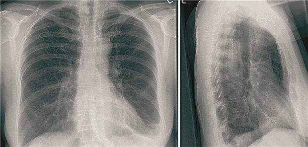 Thoraxröntgenaufnahme eines Patienten mit epitheloidem Hämangioendotheliom.