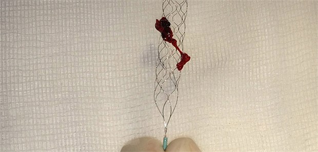 Zeitfenster bei Apoplexie größer als acht Stunden Thrombektomie: Ihr Nutzen ist durch etliche Studien im Zeitraum von sechs bis acht Stunden belegt. Eine neue Studie zeigt nun auf, dass auch danach noch etliche Patienten von dem Eingriff profitieren.
