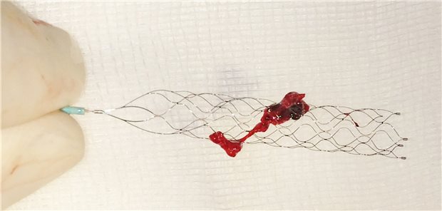 Thrombektomie bei Schlaganfall mit dem Solitaire-System.