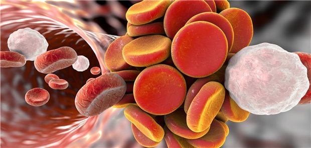 Thromben im linken Ventrikel erhöhen das Risiko für Schlaganfälle und systemische Embolien.