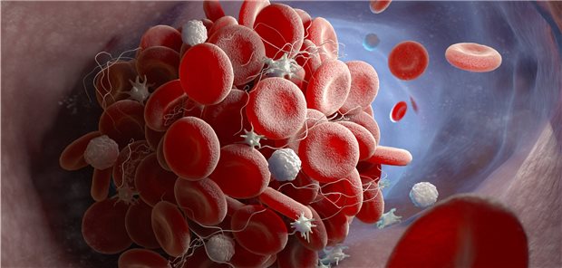 Thromboembolische Ereignisse bei mild an COVID-Erkrankten sollten nicht automatisch der SARS-CoV-2-Infektion zugeordnet werden, warnen belgische Ärzte.
