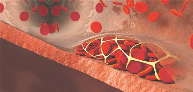 Thrombose: Bei entsprechenden Eingriffen (etwa Hüft-TEP), sollte die Prophylaxe angepasst und die Patientinnen und Patienten über typische Symptome einer Thromboembolie gründlich aufgeklärt werden.
