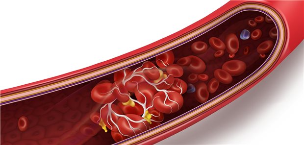 Hypothese: Immun-Thrombozytopenie durch AstraZeneca-Impfstoff? Thrombose-Bildung in einem Blutgefäß: Auslöser können bestimmte Antikörper sein.