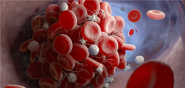Thrombose: Das Blutungsrisiko unter Antikoagulation richtig einzuschätzen, ist gerade bei älteren Patienten nicht einfach, zumal die einschlägigen Scores wenig hilfreich sind.