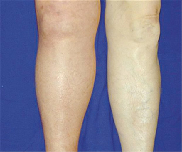 Rivaroxaban für zwei weitere Indikationen zugelassen Thrombose: Rivaroxaban jetzt auch bei tiefen Venenthrombosen zugelassen.