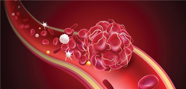 Tumorassoziierte Thrombose: Wer braucht wirklich eine dauerhafte Vollantikoagulation? Ein Thrombus in einem Blutgefäß