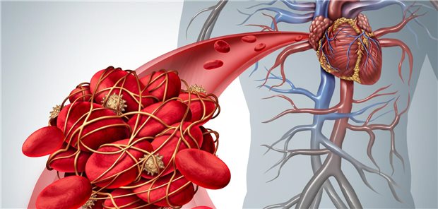 Eine Thrombose in einem Gefäß
