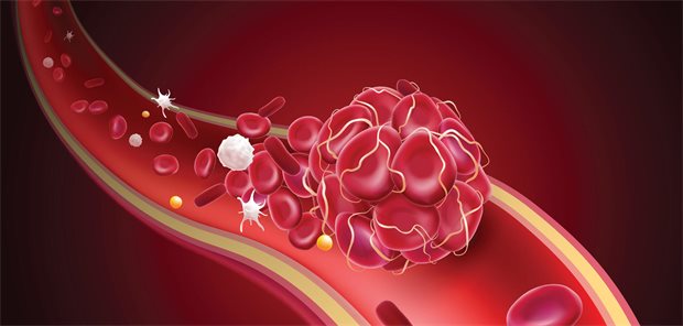Thrombus im Gefäß