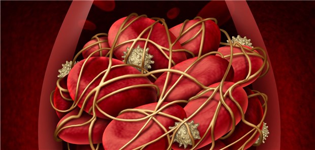 Thrombus: Die meisten VHF-Patienten, die als koronaren Schutz eine Thrombozytenhemmung benötigen, können offenbar sicher mit einer Kombi aus Antikoagulation und Clopidogrel behandelt werden.