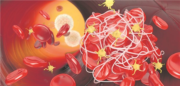 Ticagrelor eine Gratwanderung bei KHK-Patienten mit Diabetes Thrombus: Von einer Therapie mit Ticagrelor könnte eine Subgruppe von KHK-Patienten mit Diabetes profitieren.