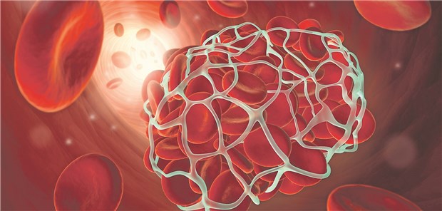 Thrombus: Zur Schlaganfallprävention ist die duale Plättchenhemmung nur kurzfristig von Vorteil.