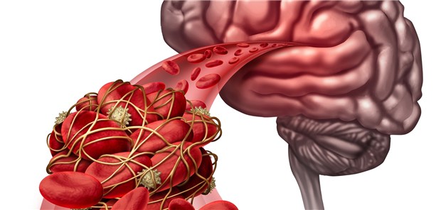 Thrombus auf dem Weg ins Gehirn: Bei manchen Schlaganfallpatienten ist weder Lyse noch Thrombektomie möglich.