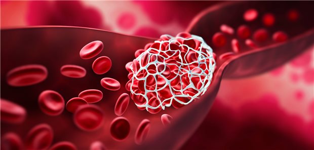 Thrombus blockiert ein Blutgefäß: Zur Prävention werden neuartige Antikoagulanzien mit vermindertem Blutungsrisiko entwickelt.
