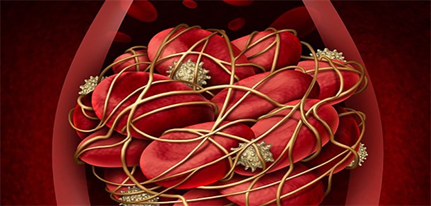 Wann eine Szintigrafie bei Verdacht auf Lungenembolie ratsam ist Thrombus in der Lunge: Schätzungsweise 7000 Menschen sterben jährlich an einer Lungenembolie.