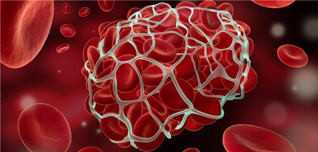 Thrombus in einem Blutgefäß: Bei einem ischämischen Insult lohnt sich eine intravenöse Lyse wohl auch bei Patienten, die orale Antikoagulantien einnehmen.