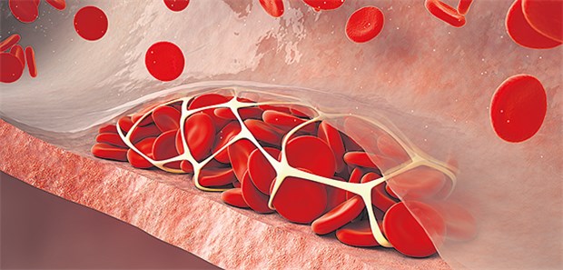 Thrombusbildung: Welche Prävention ist die günstigste?