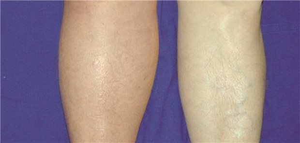 Tiefe Beinvenenthrombose: Die Prophylaxe mit Rivaroxaban könnte das Risiko reduzieren.