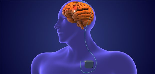 Tiefe Hirnstimulation: Das Verfahren wird bereits seit den 1980-er Jahren erfolgreich eingesetzt, vor allem bei Morbus Parkinson.