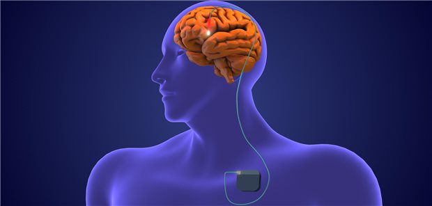 Tiefe Hirnstimulation bei Morbus Parkinson