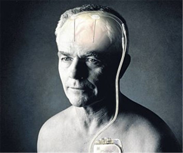 Was Hirnstimulation mit dem Charakter macht Tiefe Hirnstimulation wirkt sich auch auf die Partnerschaft aus.