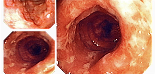 Tiefe Ulzerationen bei M. Crohn machen eine spätere Kolektomie wahrscheinlicher.