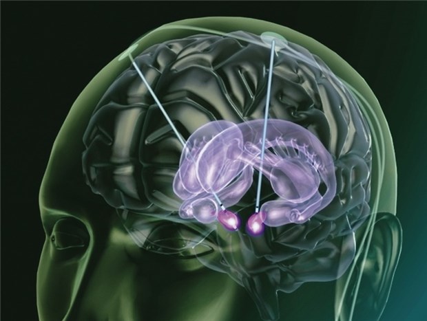 Kaum Gewebeschäden durch Hirnstimulation Tiefenhirnstimulation bei Parkinson. Hier wird oft der Nucleus subthalamicus gereizt.