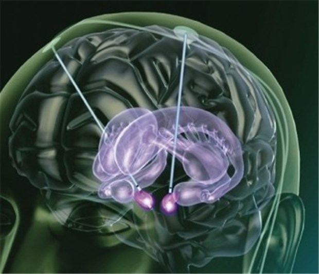 Die Hirnstimulation lindert nicht nur Akinesen und Dystonien - sie lässt auch schwer depressive Pati Tiefenhirnstimulation bei Parkinson. Hier wird oft der Nucleus subthalamicus gereizt.