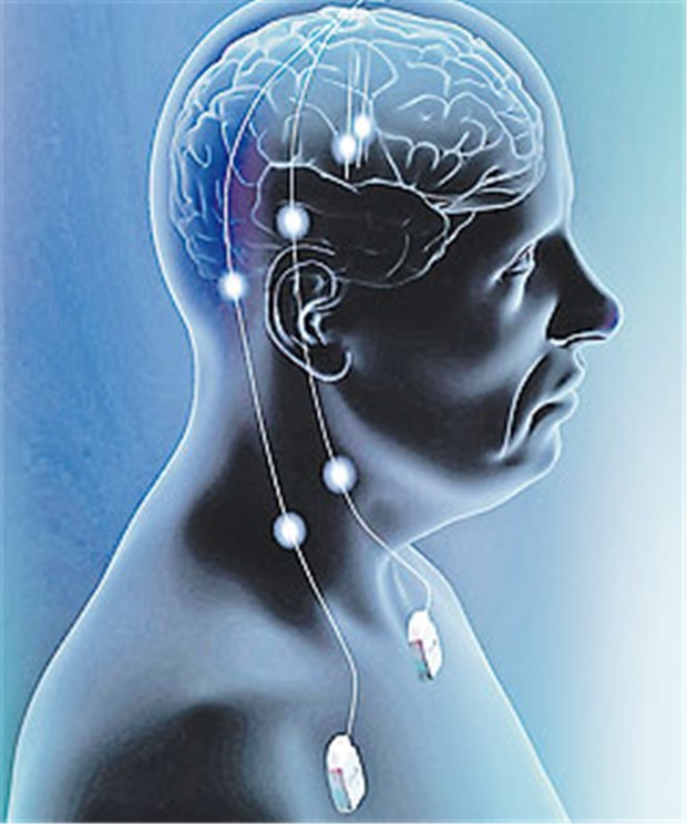 Hirnstimulation mit konstanter Stromstärke hilft bei Parkinson Tiefenhirnstimulation im menschlichen Körper.