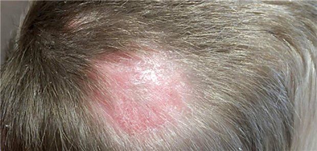 Tinea capitis auf der behaarten Kopfhaut.