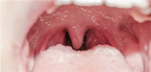 Tonsillitis: Von einem Abszess ist meist nur eine Mandel betroffen. Einer aktuellen Datenanalyse zufolge genügt es, wenn nur die betroffene Mandel entfernt wird.