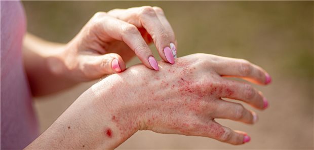 Schweres Handekzem beider Hände einer Frau