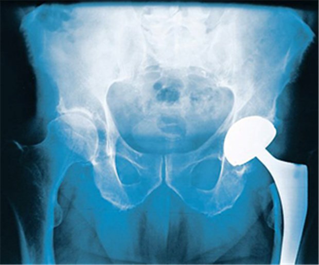 Sind Hüftimplantate aus Metall sicher? Totale Endoprothese (TEP) des Hüftgelenks im Röntgenbild.