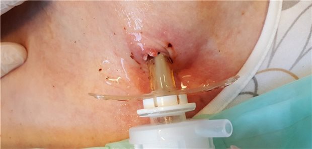 Tracheobronchomalazie: In die Siebung der Kanüle eingewachsene Trachealschleimhaut.