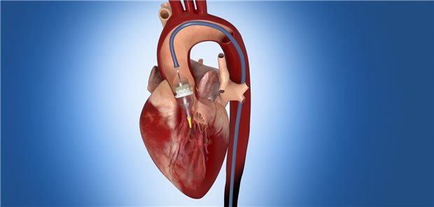 Transfemorale Positionierung einer Sapien-3-Aortenklappe via Katheter.
