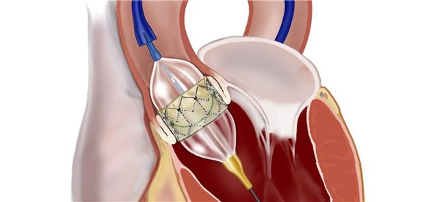 Transkatheter-Aortenklappen-Implantation (TAVI) bei Aortenstenose: Dieses Verfahren wird in den neuen europäischen Leitlinien vor allem bei älteren Patienten über 75 Jahre oder solchen mit hohem Operationsrisiko sowie bei inoperablen Patienten empfohlen (Klasse-I/A).