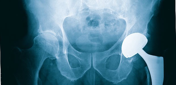 Pseudotumoren nach Oberflächenersatz häufig Trifft die metallische Kappe des Hüftkopfes auf eine ebenfalls metallische Pfanne. kann es zu Pseudotumoren kommen.