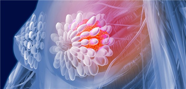 Triple-negativer Brustkrebs: Bei frühem Start der Chemo ist die Prognose besser.
