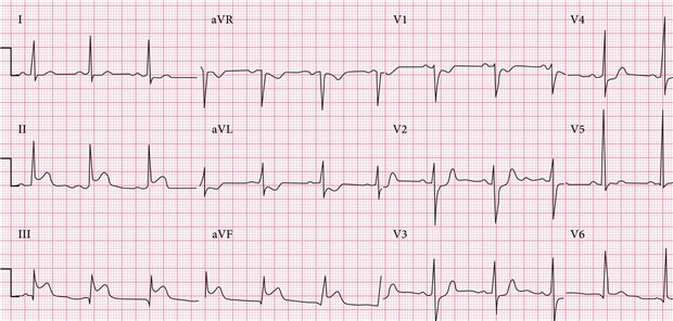 Tritt ein kardiogener Schock bei einem STEMI wie hier auf, kann mithilfe mechanischer Kreislaufunterstützungssysteme die Mortalität gesenkt werden, heißt es in einer Metaanalyse.
