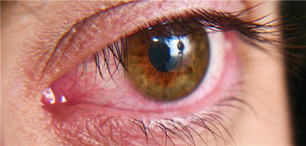 Trockene, juckende und gerötete Augen: Frauen erkranken nicht nur häufiger an einer Keratokonjunktivitis sicca, sondern sind auch stärker betroffen. (Symbolbild)